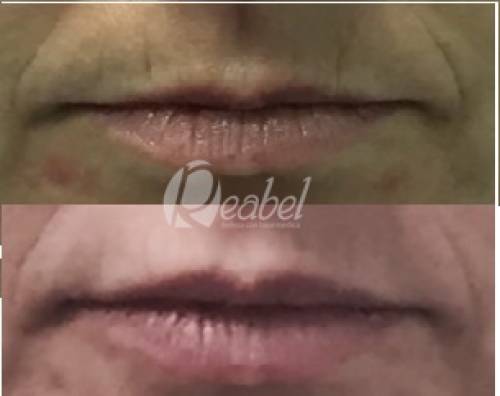 REJUVENECIMIENTO DE LABIOS